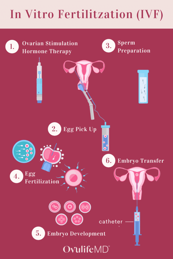 5 Essential Steps of In-Vitro Fertilization